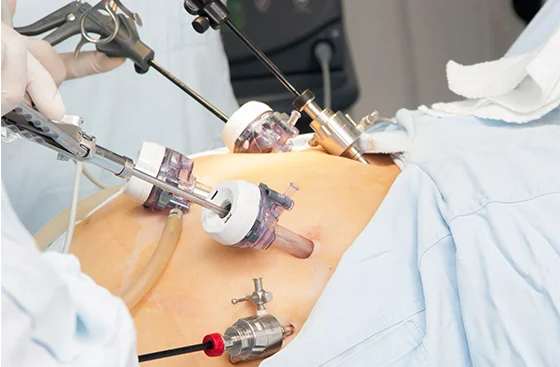 Digestive Disorder Surgery in Secunderabad