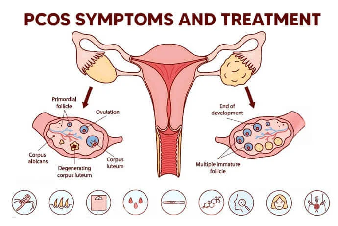 Best PCOS Symptoms and Treatment in Hyderabad